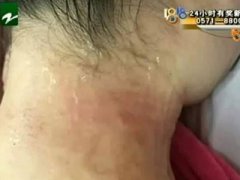 广州代妈拔火罐闻到烤肉味竟是自己的
